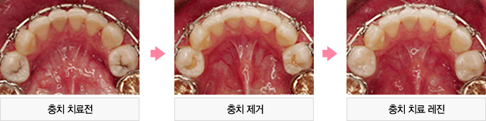 충치 치료전 / 충치 제거 / 충치 치료 레진