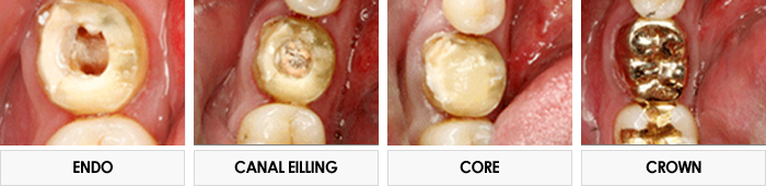 ENDO / CANAL EILLING / CORE / CROWN