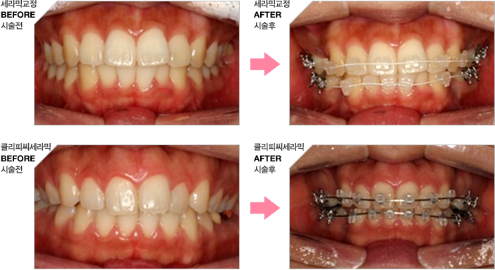 세라믹 교정치료사례 이미지