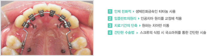 1. 인체 친화적 | 생체친화금속인 티타늄 사용
2. 임플란트의원리 | 인공치아 원리를 교정에 적용
3. 치료기간의 단축 | 원하는 치아만 이동
4. 간단한 수술법 | 스크류의 식립 시 국소마취를 통한 간단한 시술 
