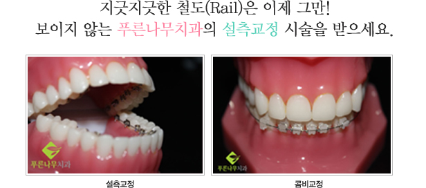 지긋지긋한 철도(Rail)은 이제 그만!
보이지 않는 푸른나무치과의 설측교정 시술을 받으세요.