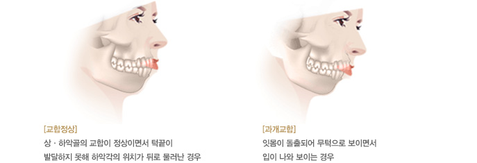 [교합정상]
상·하악골의 교합이 정상이면서 턱끝이 
발달하지 못해 하악각의 위치가 뒤로 물러난 경우 ,
[과개교합]
잇몸이 돌출되어 무턱으로 보이면서
입이 나와 보이는 경우