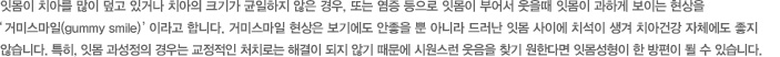 잇몸이 치아를 많이 덮고 있거나 치아의 크기가 균일하지 않은 경우, 또는 염증 등으로 잇몸이 부어서 웃을때 잇몸이 과하게 보이는 현상을 거미스마일(gummy smile)  이라고 합니다. 거미스마일 현상은 보기에도 안좋을 뿐 아니라 드러난 잇몸 사이에 치석이 생겨 치아건강 자체에도 좋지 
않습니다. 특히, 잇몸 과성정의 경우는 교정적인 처치로는 해결이 되지 않기 때문에 시원스런 웃음을 찾기 원한다면 잇몸성형이 한 방편이 될 수 있습니다.