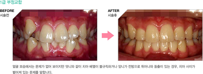 1급부정교합 - 얼굴 모습에서는 문제가 없어 보이지만 덧니와 같이 치아 배열이 불규칙하거나 앞니가 전방으로 튀어나와 돌출이 있는 경우, 치아 사이가 벌어져 있는 문제를 말합니다.