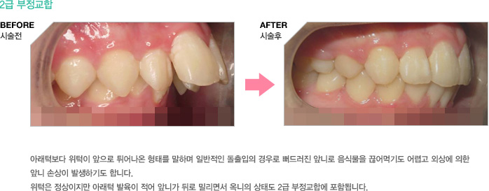 2급부정교합 - 아래턱보다 위턱이 앞으로 튀어나온 형태를 말하며 일반적인 돌출입의 경우로 뻐드러진 앞니로 음식물을 끊어먹기도 어렵고 외상에 의한 앞니 손상이 발생하기도 합니다. 위턱은 정상이지만 아래턱 발육이 적어 앞니가 뒤로 밀리면서 옥니의 상태도 2급 부정교합에 포함됩니다.