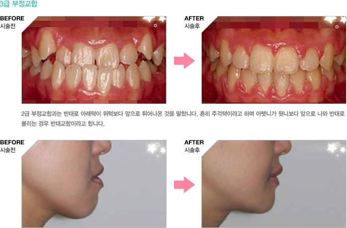 3급부정교합 - 2급 부정교합과는 반대로 아래턱이 위턱보다 앞으로 튀어나온 것을 말합니다. 흔히 주걱턱이라고 하며 아랫니가 윗니보다 앞으로 나와 반대로 물리는 경우 반대교합이라고 합니다.
