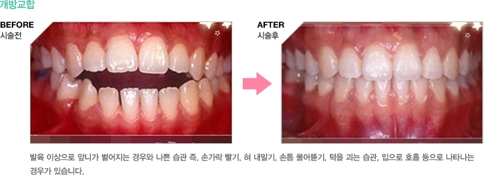 개방교합 - 발육 이상으로 앞니가 벌어지는 경우와 나쁜 습관 즉, 손가락 빨기, 혀 내밀기, 손톱 물어뜯기, 턱을 괴는 습관, 입으로 호흡 등으로 나타나는 경우가 있습니다.