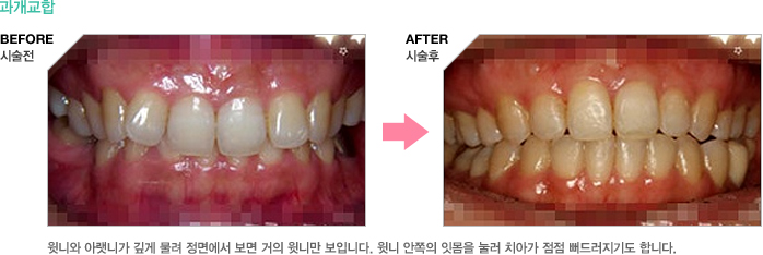 과개교합 - 윗니와 아랫니가 깊게 물려 정면에서 보면 거의 윗니만 보입니다. 윗니 안쪽의 잇몸을 눌러 치아가 점점 뻐드러지기도 합니다.