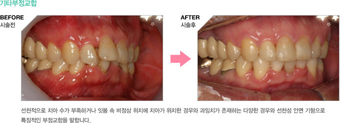 기타부정교합 - 선천적으로 치아 수가 부족하거나 잇몸 속 비정상 위치에 치아가 위치한 경우와 과잉치가 존재하는 다양한 경우와 선천성 안면 기형으로 특징적인 부정교합을 말합니다.