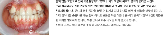 좋지 않은 교합으로 인해 턱관절장애가 있으나, 치아 모양이 예쁘고 변색이 없다면 시간이 
오래 걸리더라도 치아교정을 하는 것이 턱관절장애와 덧니를 같이 치료할 수 있는 효과적인 
치료방법입니다. 덧니의 경우 공간을 늘릴 수 없기에 치아 하나를 빼서 재 배열을 해줘야 하는데,
이때 튀어나온 송곳니를 빼는 것이 아니고 보통은 작은 어금니 중 이미 충치가 있거나 신경치료를 
한 치아를 발치하게 됩니다. 보통 덧니로 자주 나오는 이가 송곳니 입니다.
치아가 고르지 않기 때문에 웃을 때 자연스럽지도 예쁘지도 않습니다.