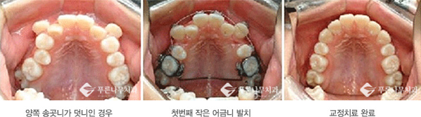 좋지 않은 교합으로 인해 턱관절장애가 있으나, 치아 모양이 예쁘고 변색이 없다면 시간이 
오래 걸리더라도 치아교정을 하는 것이 턱관절장애와 덧니를 같이 치료할 수 있는 효과적인 
치료방법입니다. 덧니의 경우 공간을 늘릴 수 없기에 치아 하나를 빼서 재 배열을 해줘야 하는데,
이때 튀어나온 송곳니를 빼는 것이 아니고 보통은 작은 어금니 중 이미 충치가 있거나 신경치료를 
한 치아를 발치하게 됩니다. 보통 덧니로 자주 나오는 이가 송곳니 입니다.
치아가 고르지 않기 때문에 웃을 때 자연스럽지도 예쁘지도 않습니다.