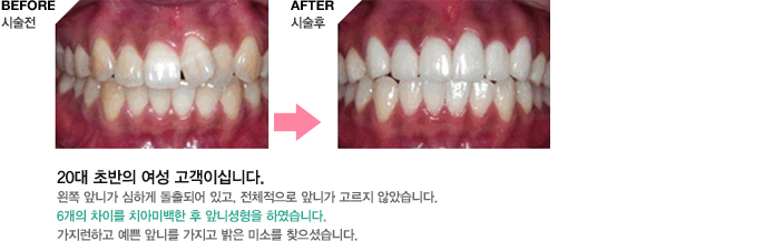 20대 초반의 여성 고객이십니다.
왼쪽 앞니가 심하게 돌출되어 있고, 전체적으로
앞니가 고르지 않았습니다.
6개의 차이를 치아미백한 후 앞니셩형을 하였습
니다. 
가지런하고 예쁜 앞니를 가지고 밝은 미소를
찾으셨습니다.
