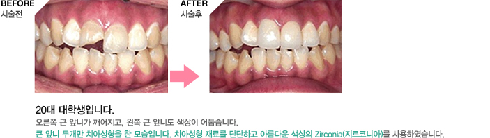 20대 대학생입니다.
오른쪽 큰 앞니가 깨어지고, 왼쪽 큰 앞니도
색상이 어둡습니다. 
큰 앞니 두개만 치아성형을 한 모습입니다.
치아성형 재료를 단단하고 아름다운 색상의
Zirconia(지르코니아)를 사용하였습니다.
